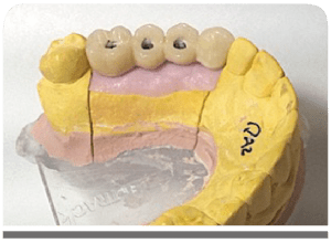 Hybrid dentures &#038; Fixed dentures
