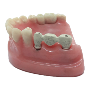 Hybrid dentures &#038; Fixed dentures